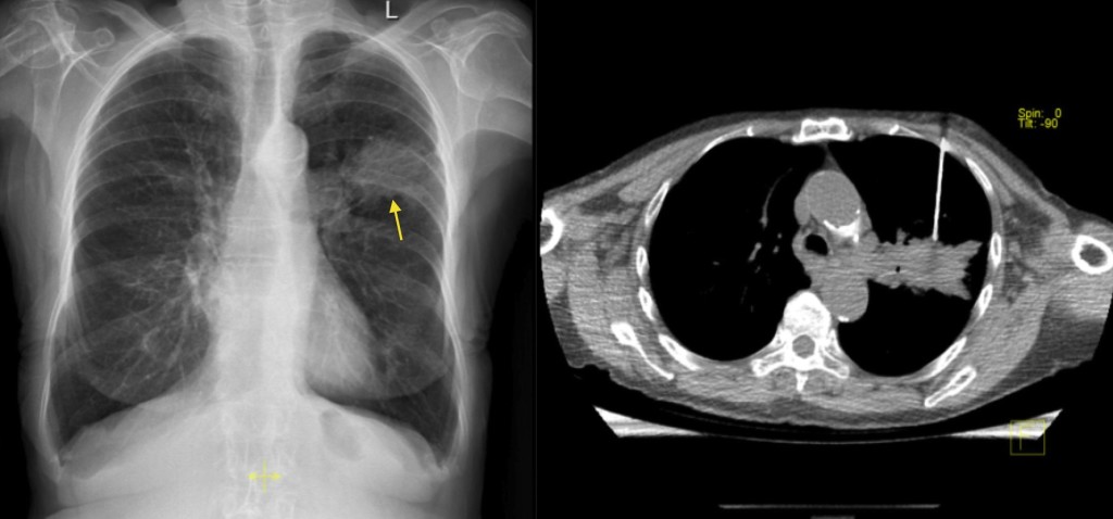 Image Guided Biopsy Radiology At St Vincent S University Hospital