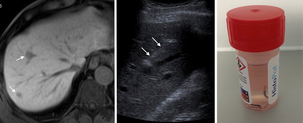 image-guided-biopsy-radiology-at-st-vincent-s-university-hospital