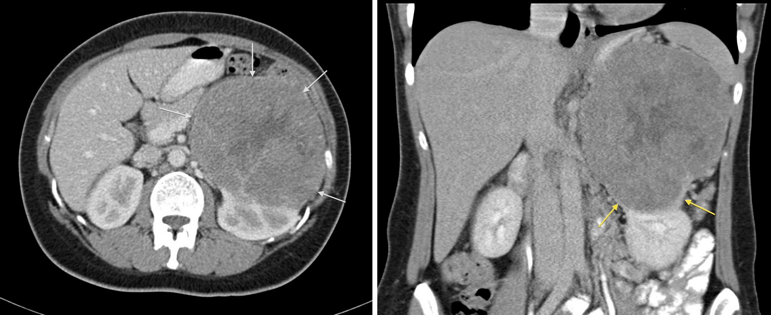 Renal Cell Carcinoma Radiology At St Vincent S University Hospital My 