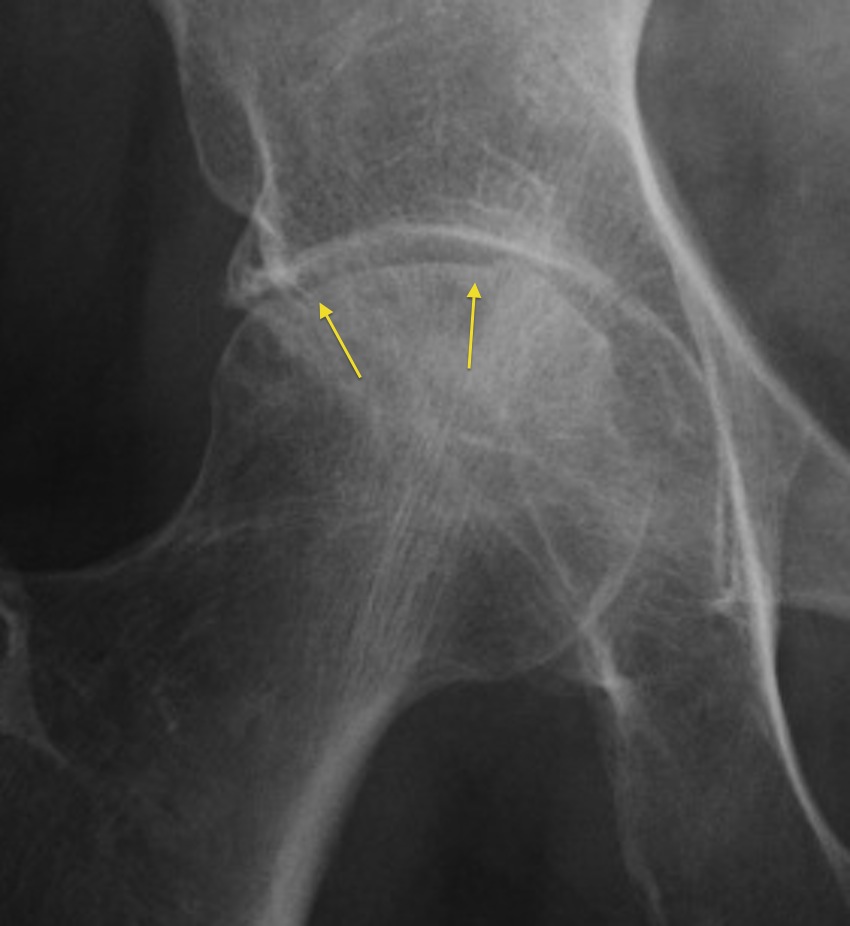 The Lesions In The Right Femoral Head Subchondral Bone Necrosis My
