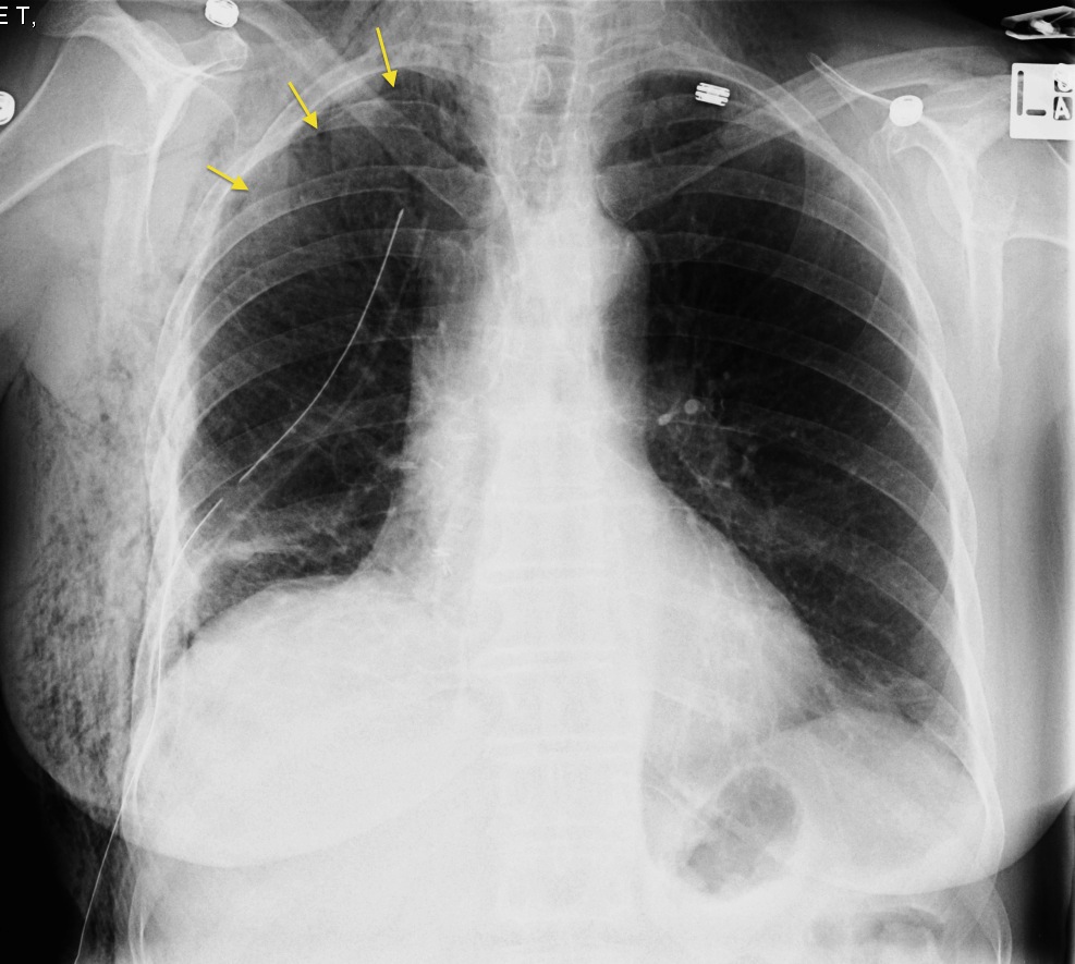 Pneumothorax And Surgical Emphysema Radiology At St Vincent S My Xxx