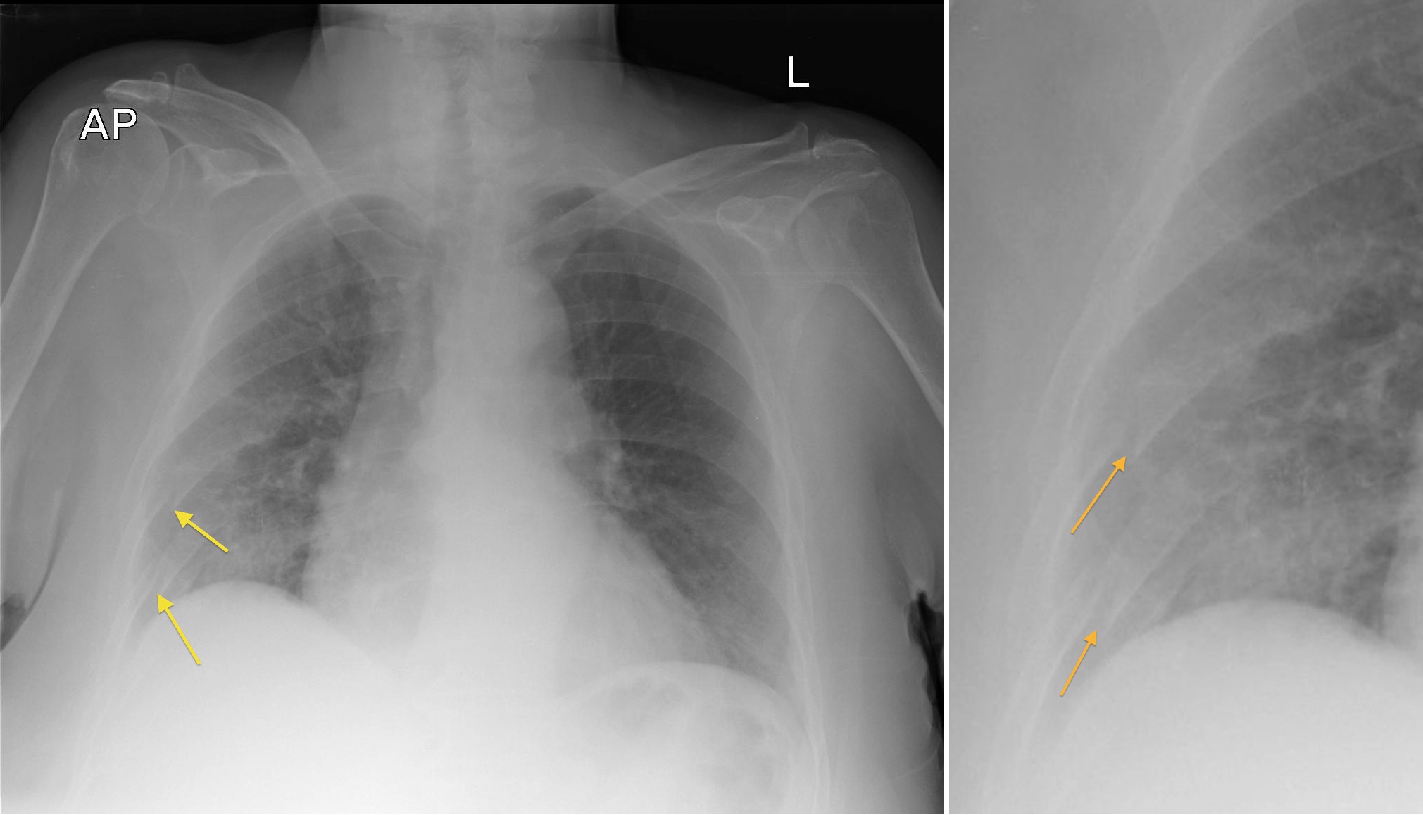 Rib Fractures Radiology At St Vincent s University Hospital