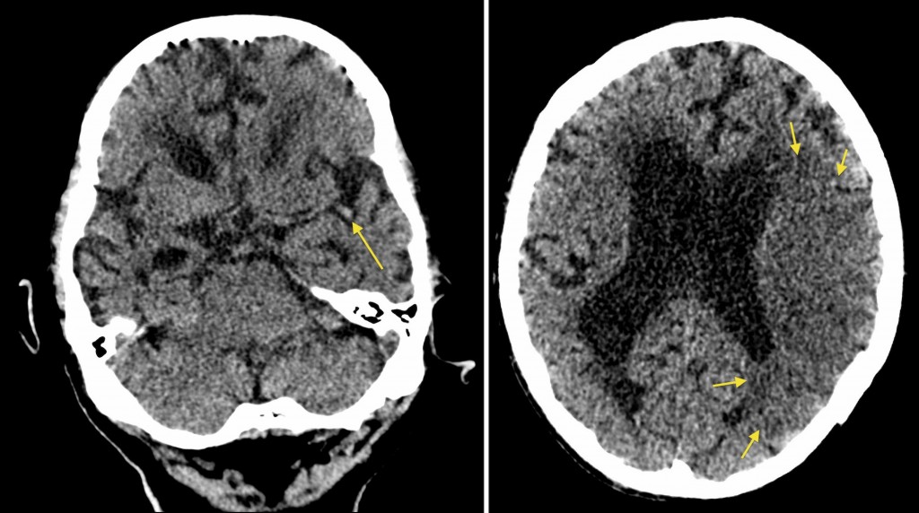 Acute MCA Infarct Dot Sign Radiology At St Vincent s University Hospital