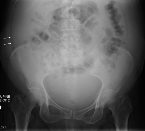 Ascites Radiology At St Vincents University Hospital