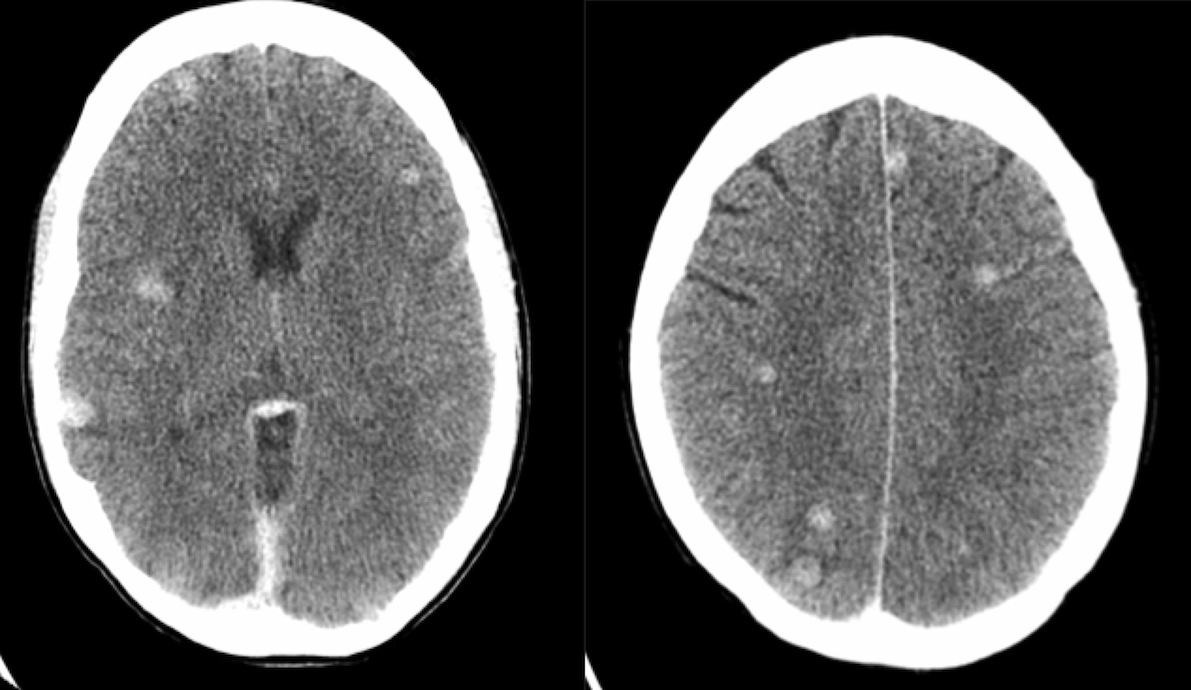 Brain Metastases Radiology At St Vincent s University Hospital