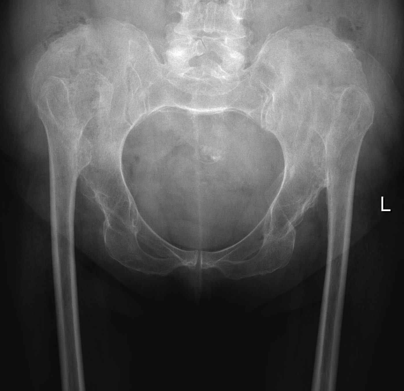 Developmental Dysplasia Of The Hips Radiology At St Vincent S My XXX Hot Girl