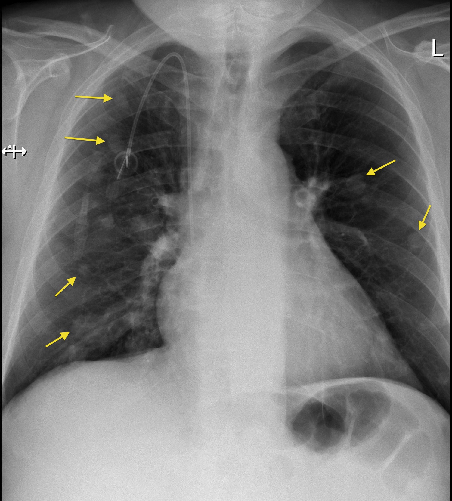 Lung Metastases Portacath Radiology At St Vincent s University Hospital