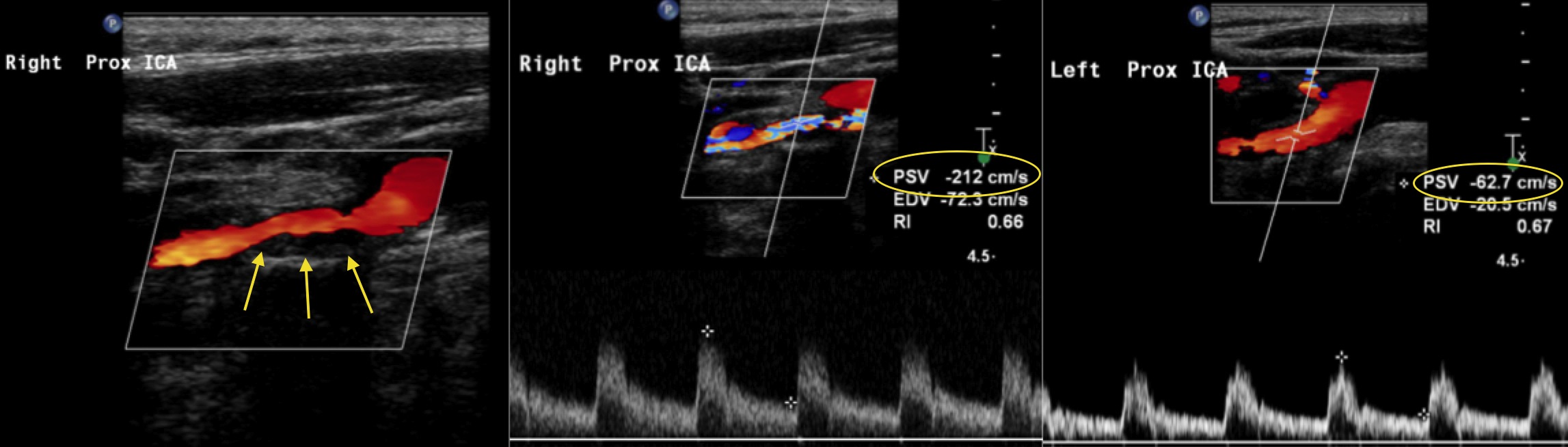 carotid doppler radiology