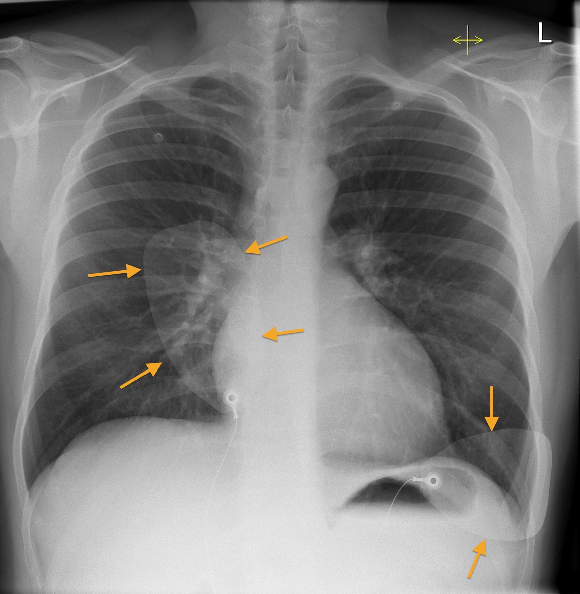 defibrillation-pads-cxr-radiology-at-st-vincent-s-university-hospital