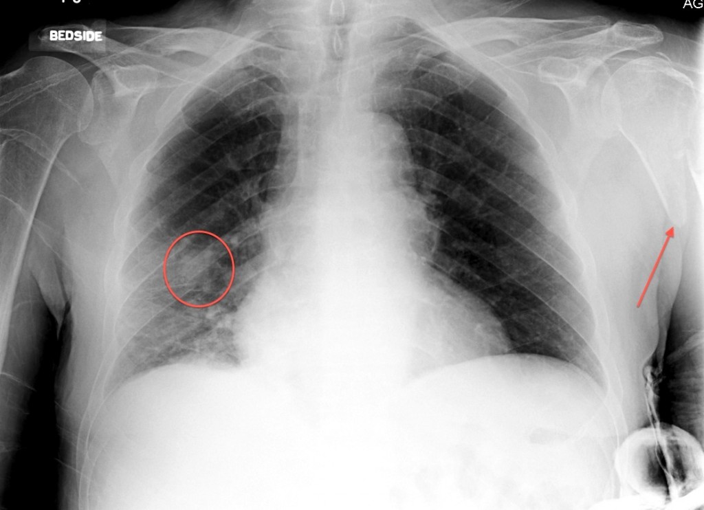 Lung Cancer With Bone Metastasis Radiology At St Vincent s 