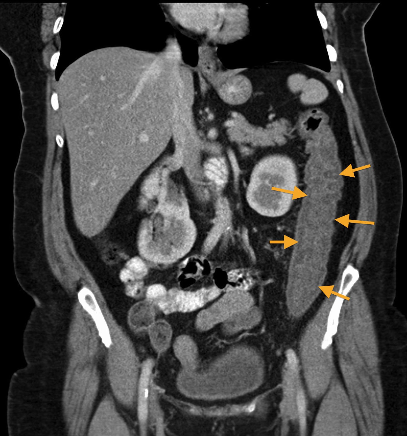 Colitis Ct Radiology At St Vincents University Hospital