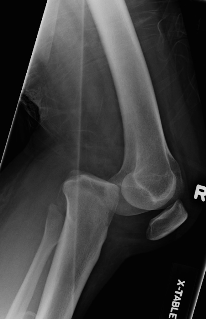 Posterior Knee Dislocation Radiology At St Vincents University Hospital