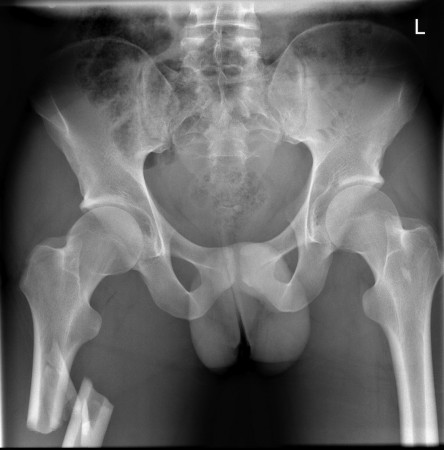 Femur fracture