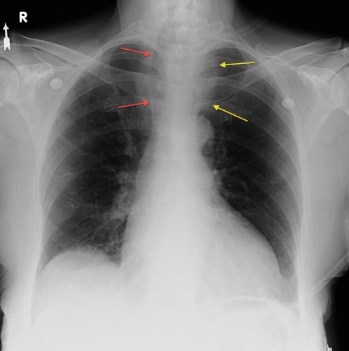 anterior-mediastinal-mass-radiology-at-st-vincent-s-university-hospital