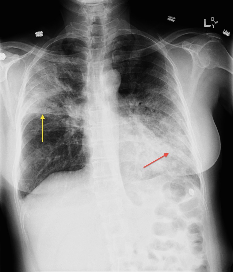 Right Upper Lobe And Lingular Consolidation Radiology At St Vincent 