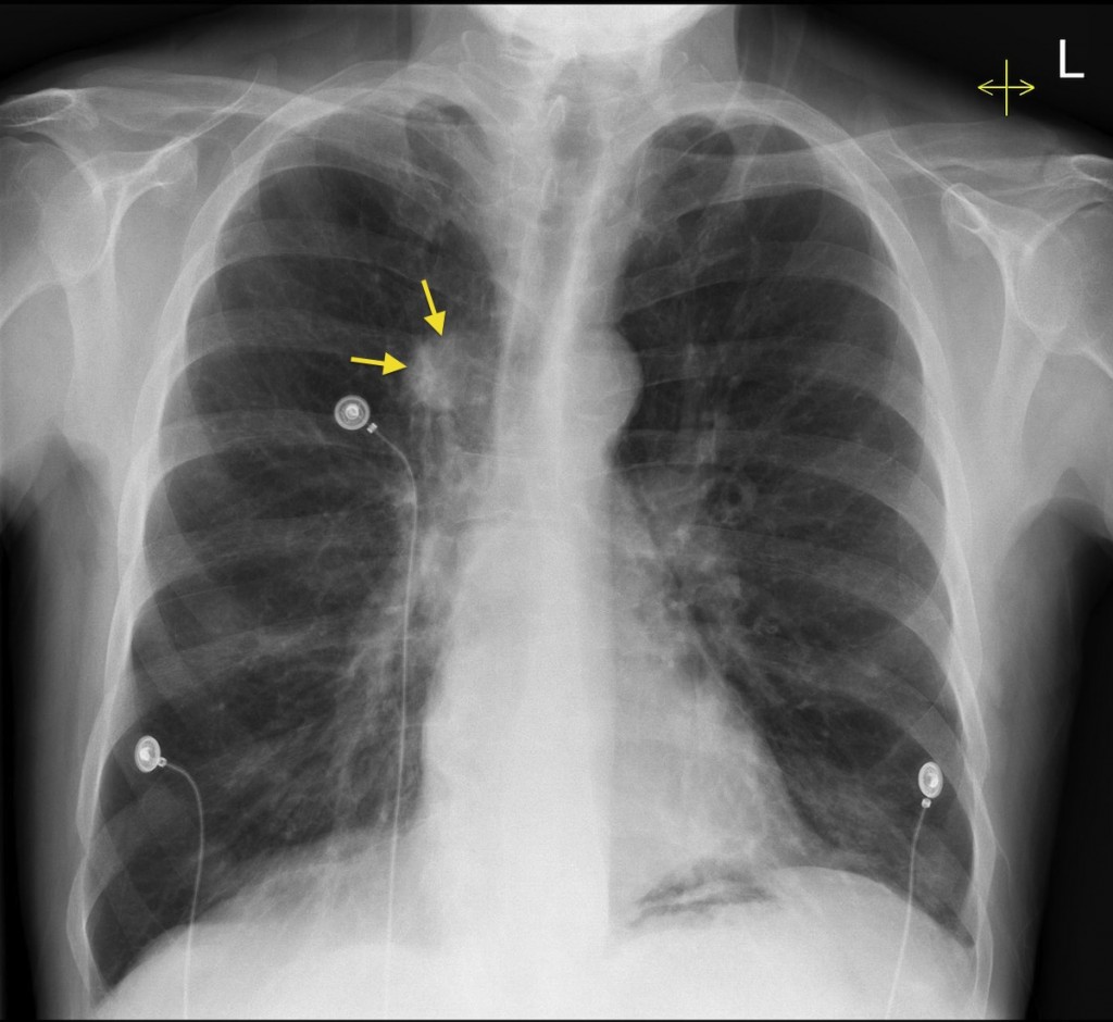 Lung Cancer CXR Radiology At St Vincent s University Hospital