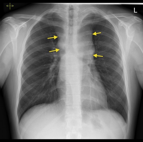 pdf-diagnostic-dilemma-of-an-anterior-mediastinal-mass