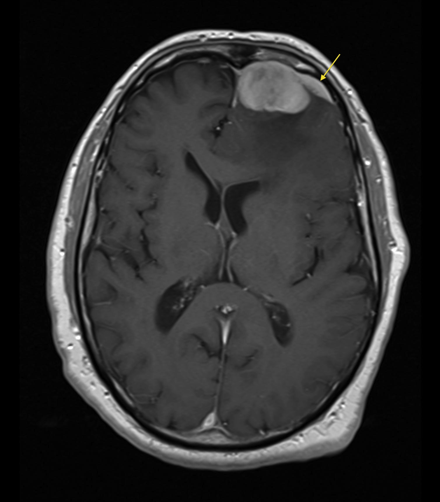 Meningioma Radiology At St Vincent S University Hospital Hot Sex Picture 6820