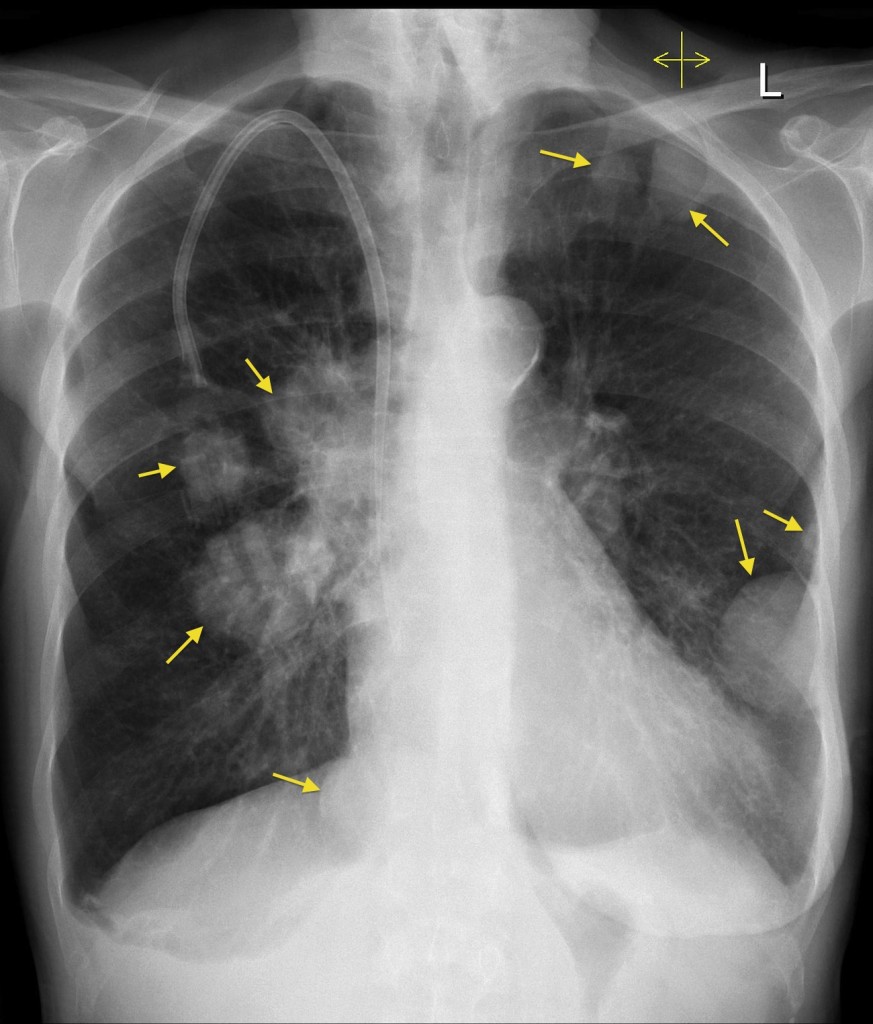 Lung Metastases Breast Cancer Radiology At St Vincent s University 