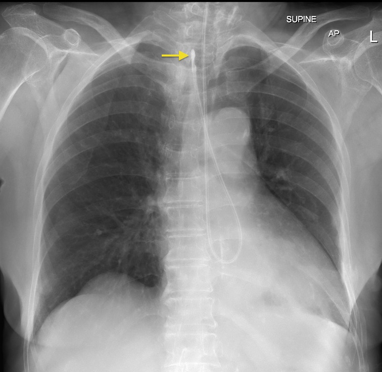 Malpositioned NG Tube Radiology At St Vincent s University Hospital