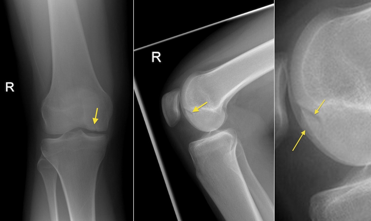 Osteochondral defect, knee - Radiology at St. Vincent's University Hospital