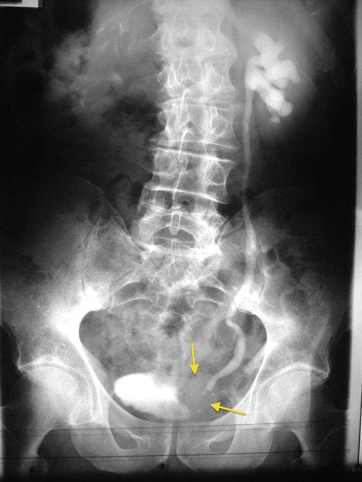 Obstructing Bladder TCC Radiology At St Vincent s University Hospital