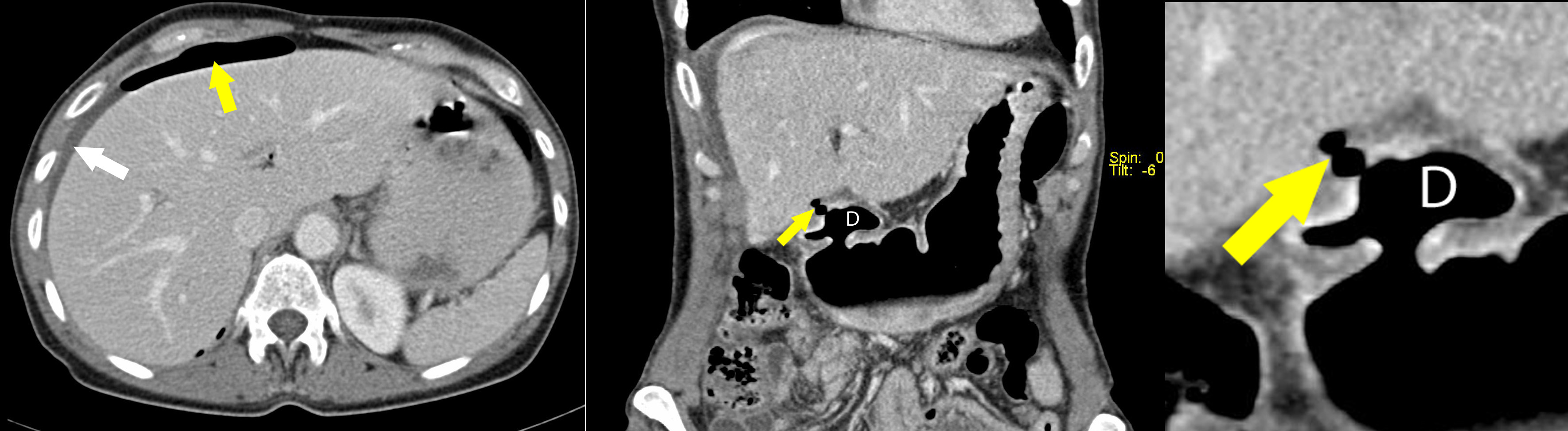 Gastric Ulcer Without Hemorrhage Or Perforation Icd 10