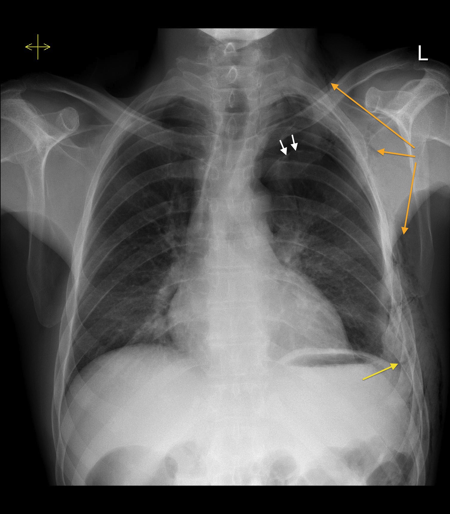 Tension Pneumothorax Due To Rib Fracture Radiology At St Vincent S