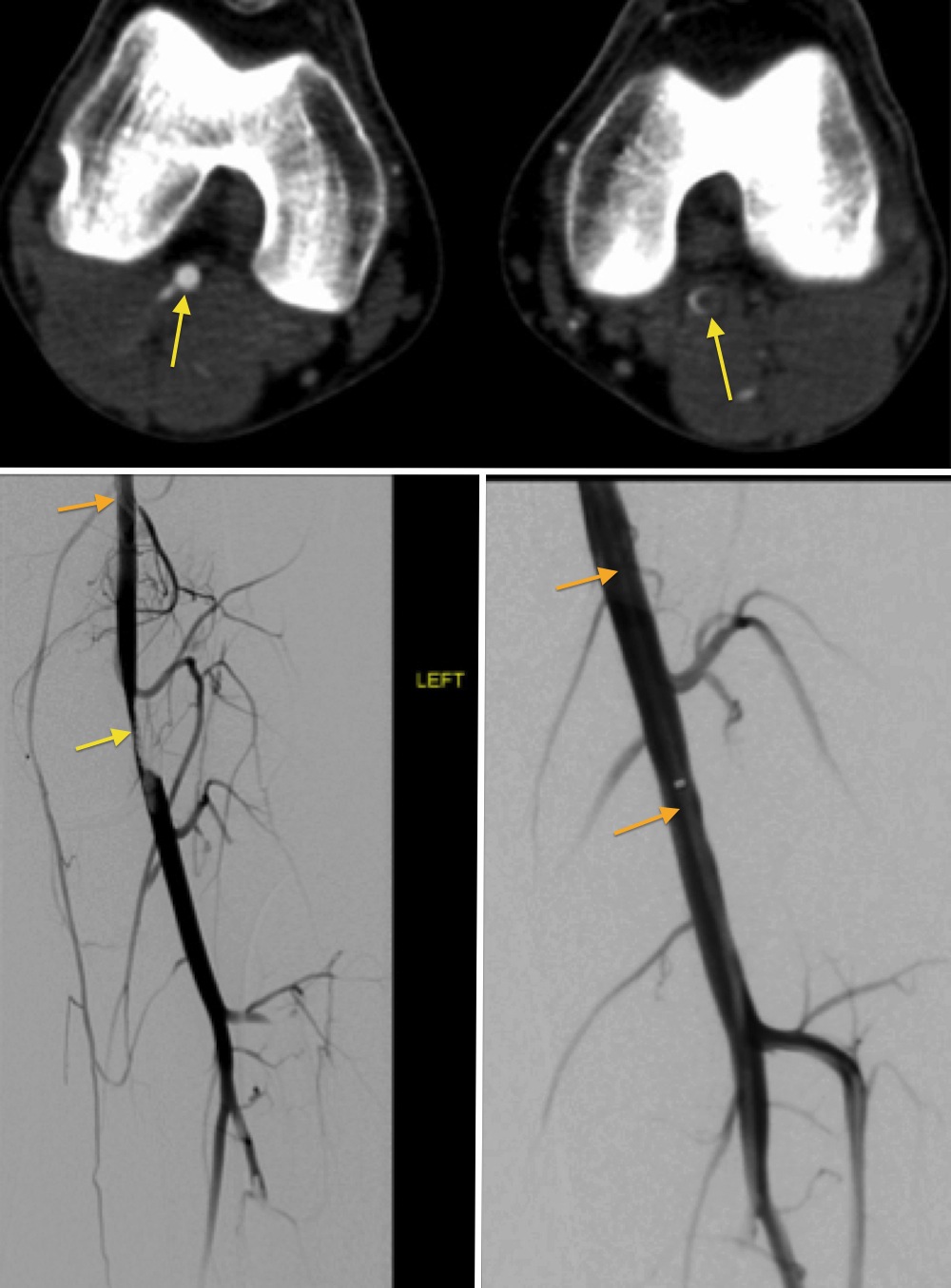 Popliteal Entrapment Syndrome Thrombolysis Radiology At St Vincent