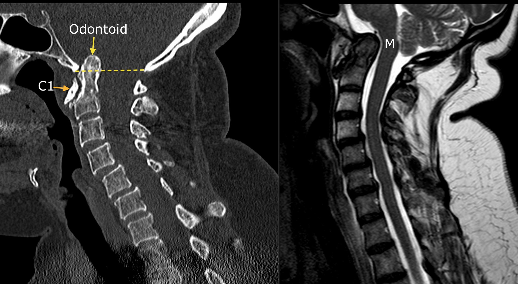 Basilar Impression Radiology At St Vincent s University Hospital