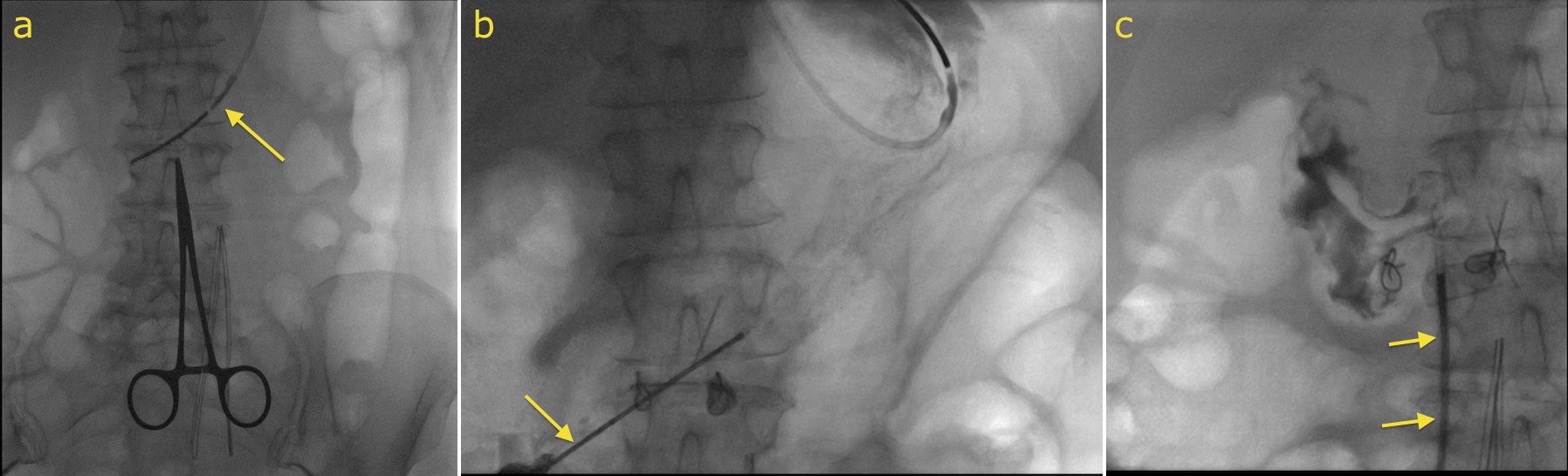 Gastrostomy Tube Insertion Rig Radiology At St Vincent S University Hospital