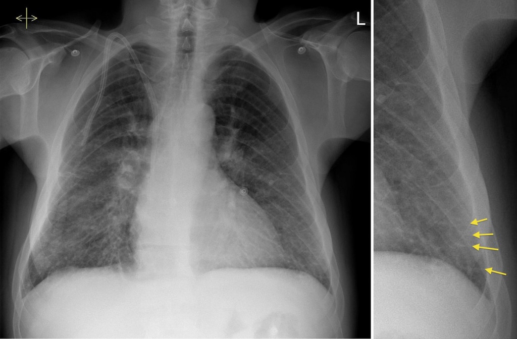 Pulmonary Oedema Renal Failure Radiology At St Vincent s 