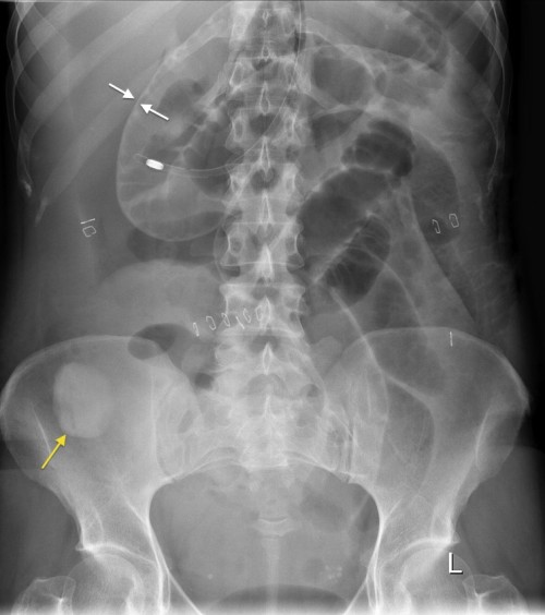 Riglerspostop Radiology At St Vincent S University Hospital