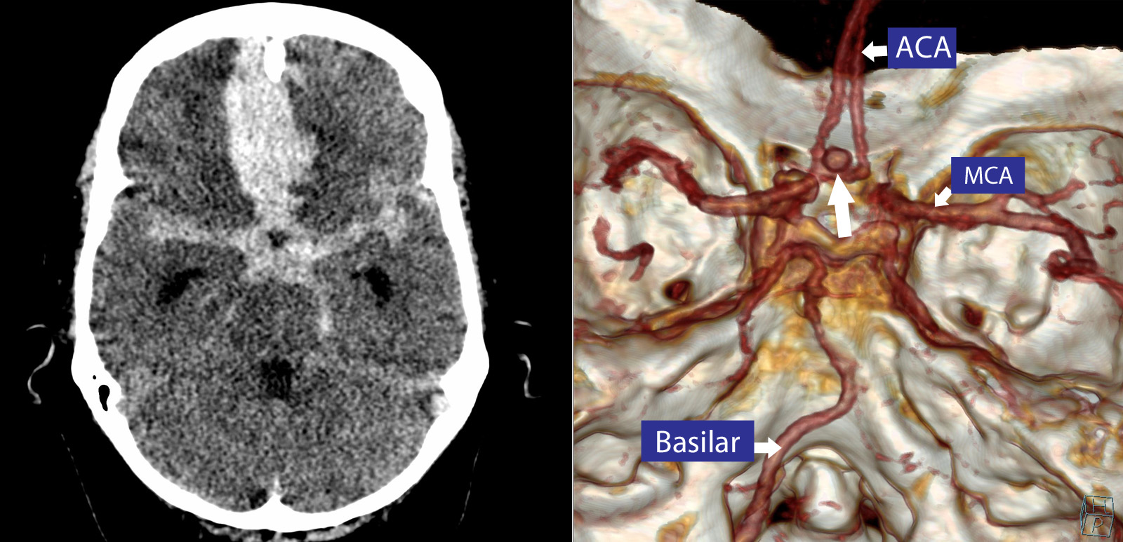 CT brain image gallery - SAH