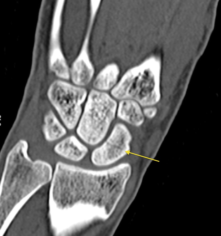 Scaphoid Fracture Imaging Practice Essentials Radiography Computed My