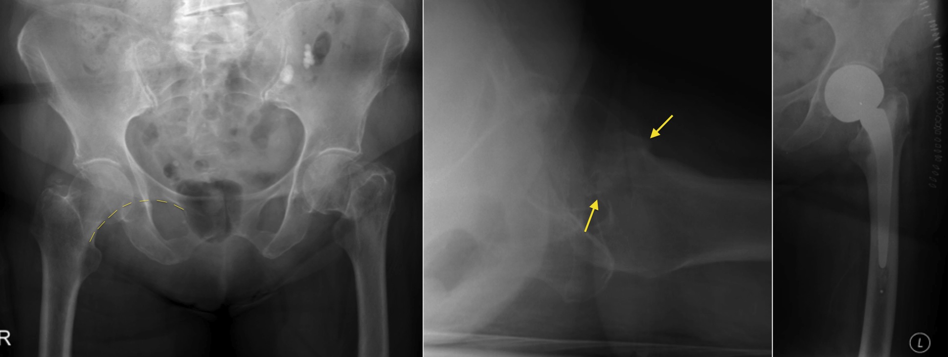 femoral neck fracture complications