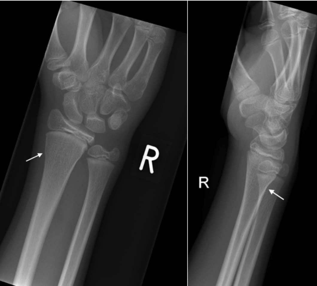 buckle fracture wrist