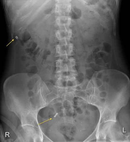 Tubalclipsmigrated - Radiology At St. Vincent's University Hospital