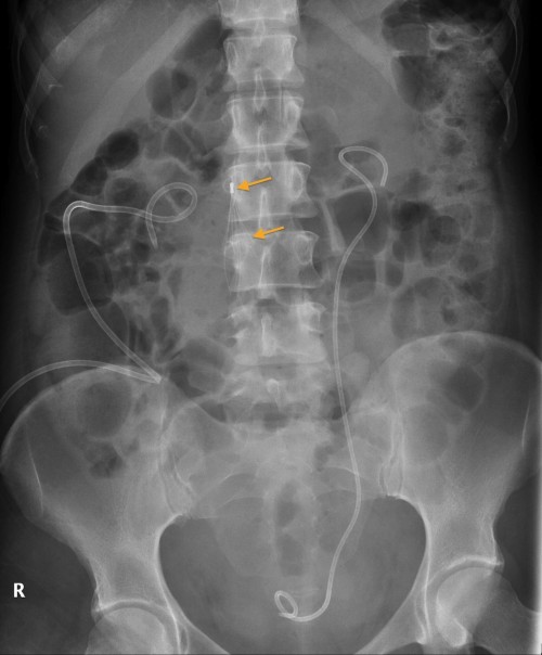 Uretericstentandivcf Radiology At St Vincent S University Hospital