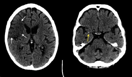 Acute infarct with dense MCA sign