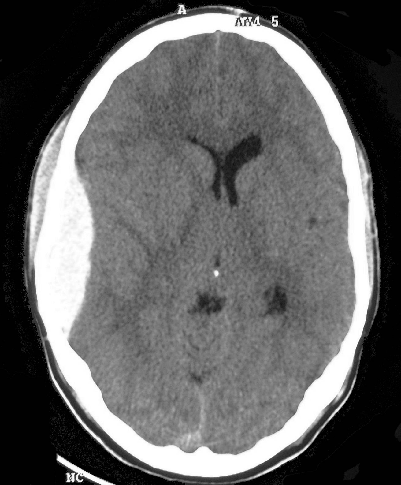 Extradural Haematoma Radiology At St Vincents University Hospital