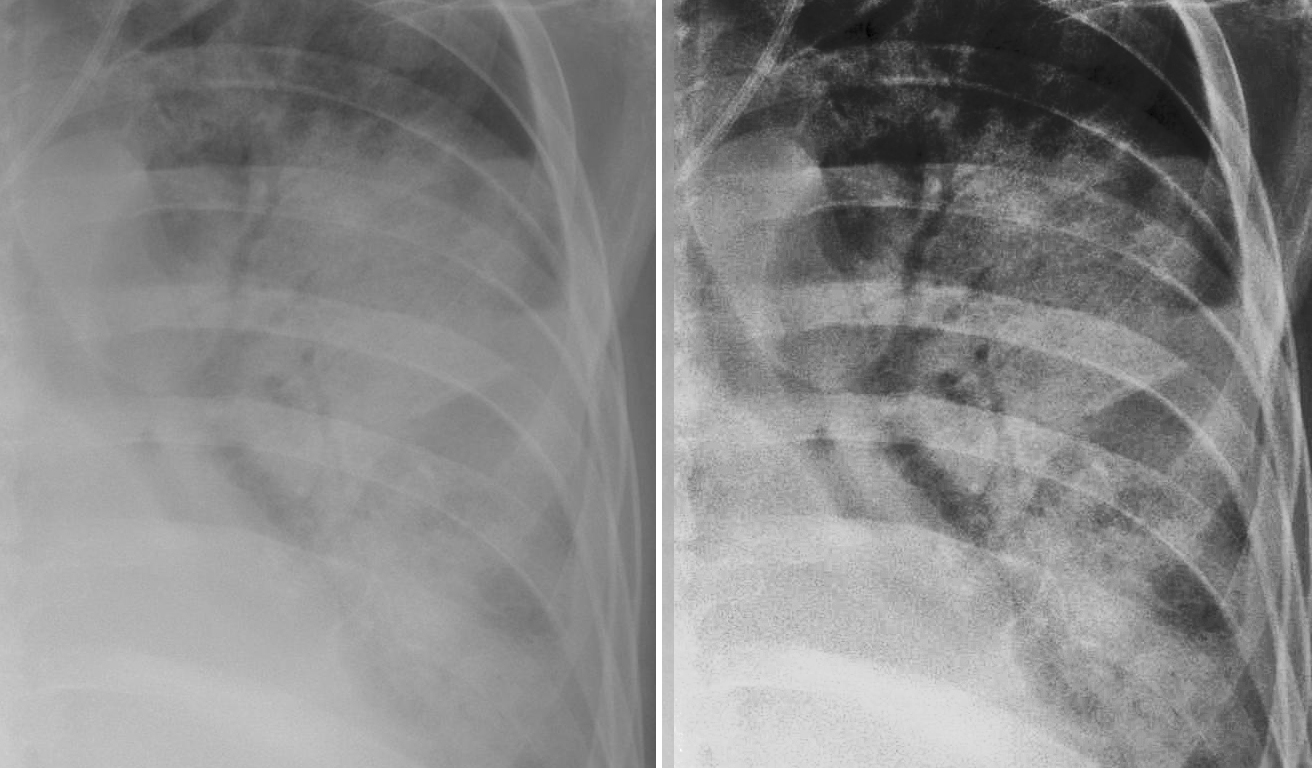 Acute Respiratory Distress Syndrome Ards Chest X Ray Radiology At St Vincent S University Hospital