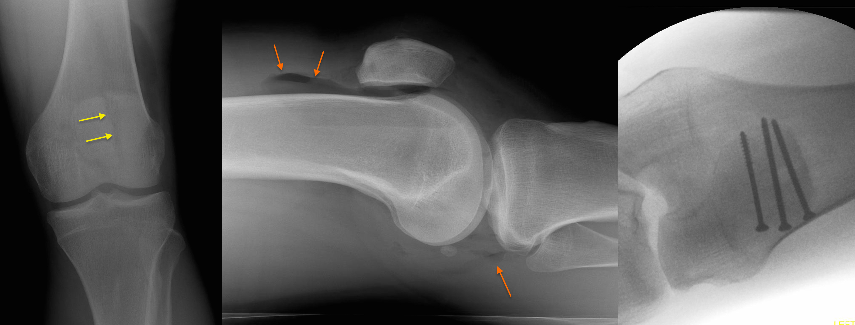 Compound Patellar Fracture Radiology At St Vincent S University Hospital