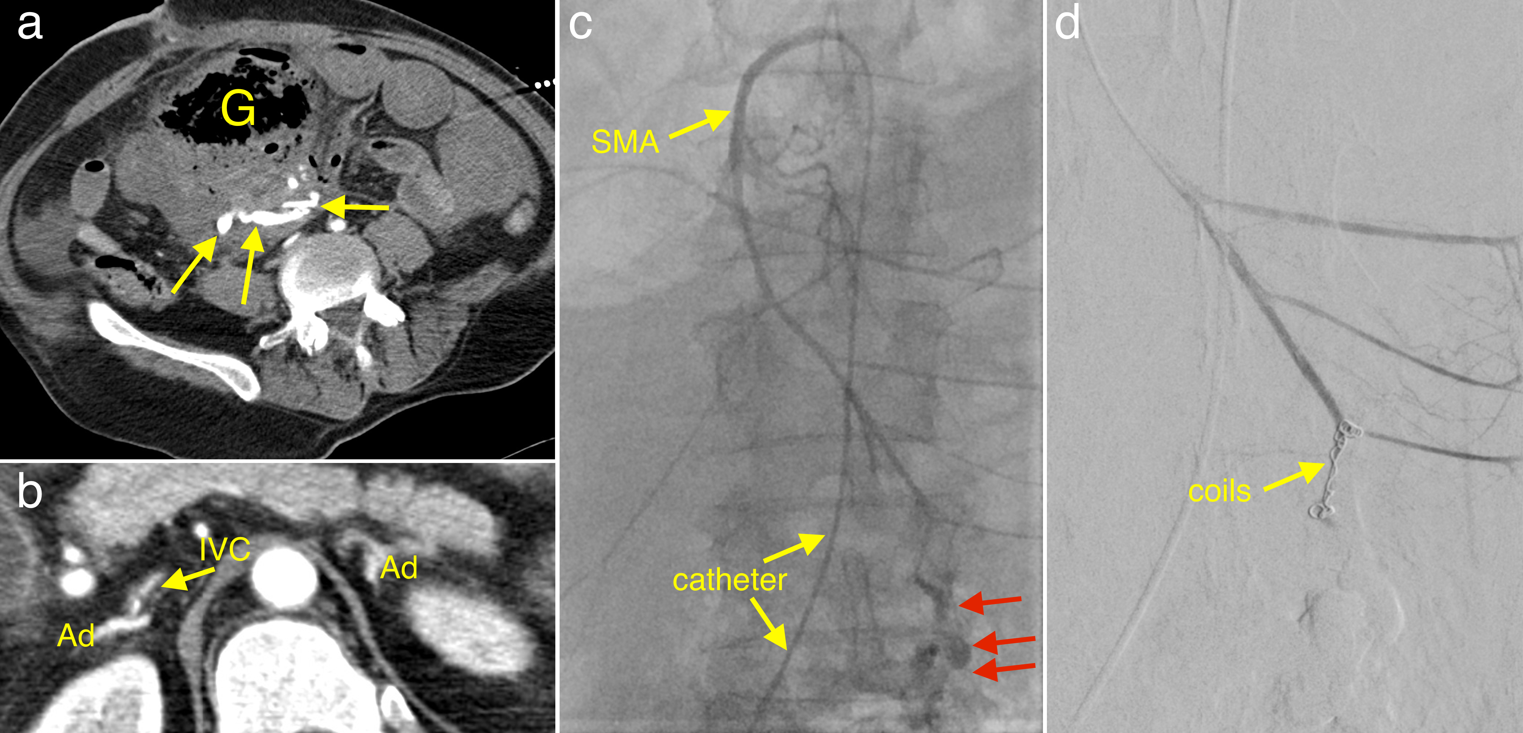 Embolization Of Superior Mesenteric Artery Haemorrhage Radiology At