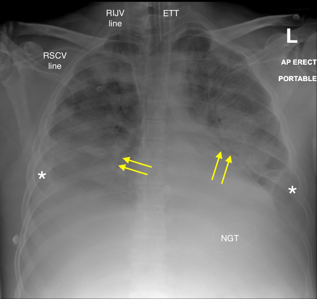 Acute Respiratory Distress Syndrome Ards Chest X Ray Radiology At My XXX Hot Girl