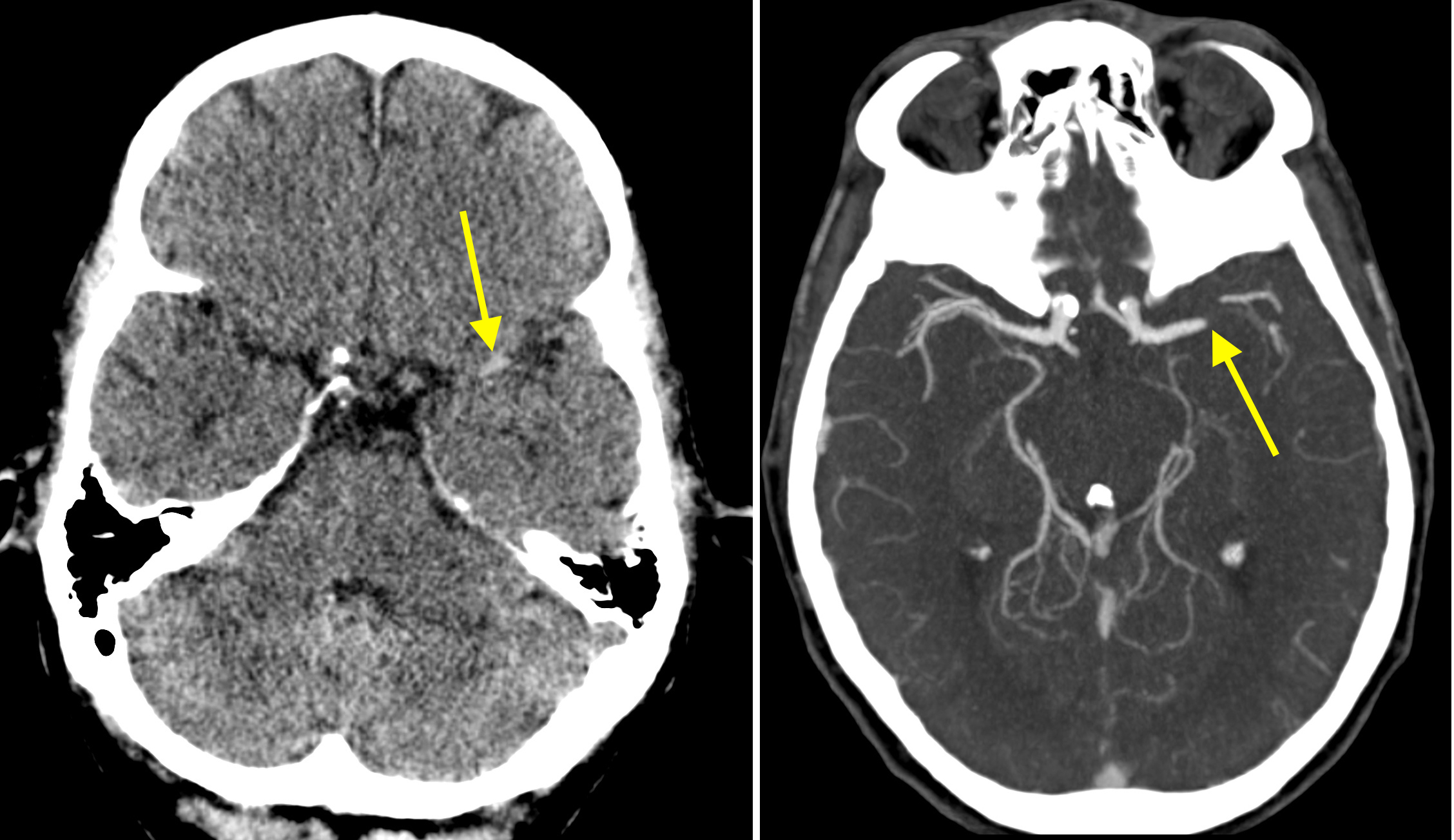 Occluded Middle Cerebral Artery On Ct Angiography Radiology At St Vincent S University Hospital