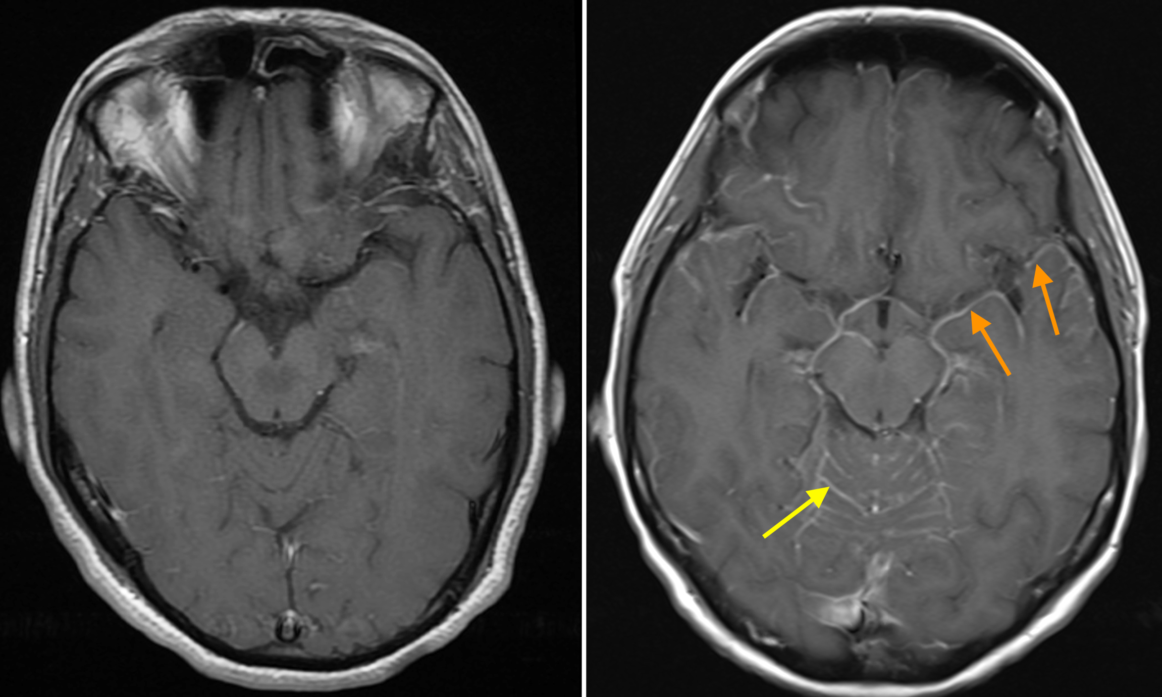 liver-metastases-radiology-key