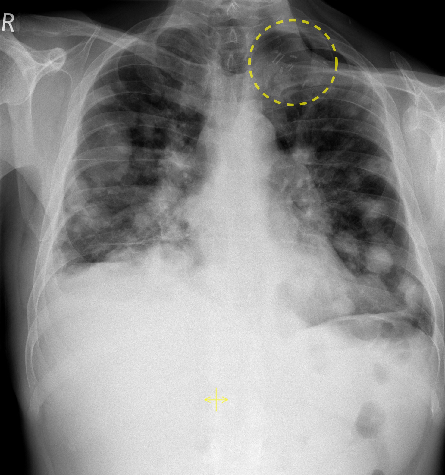 Lung Metastases From Head And Neck Cancer Radiology At St Vincent s 