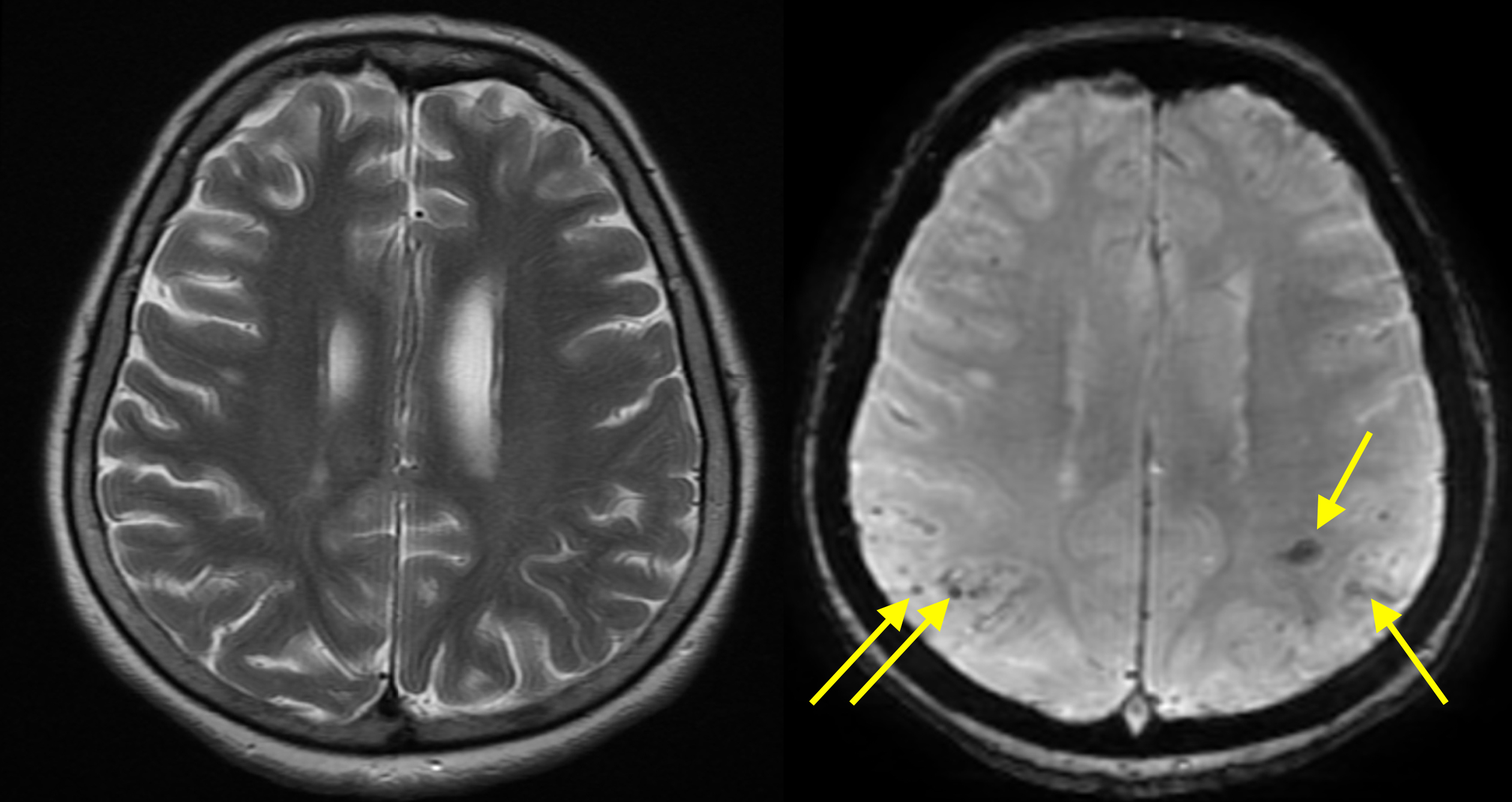 BetaAmyloid Plaques In The Brain at Miguel Nguyen blog