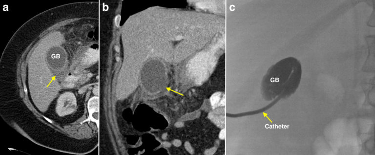 Cholecystostomy Radiology At St Vincents University Hospital 1567